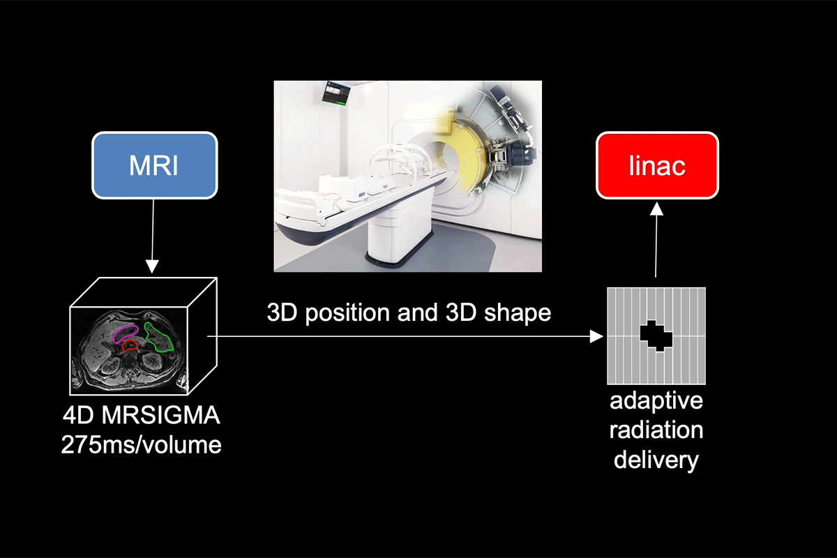 Figure 3: Real-time 4D MRI using MRSIGMA for adaptive delivery of radiation on a MR-linac