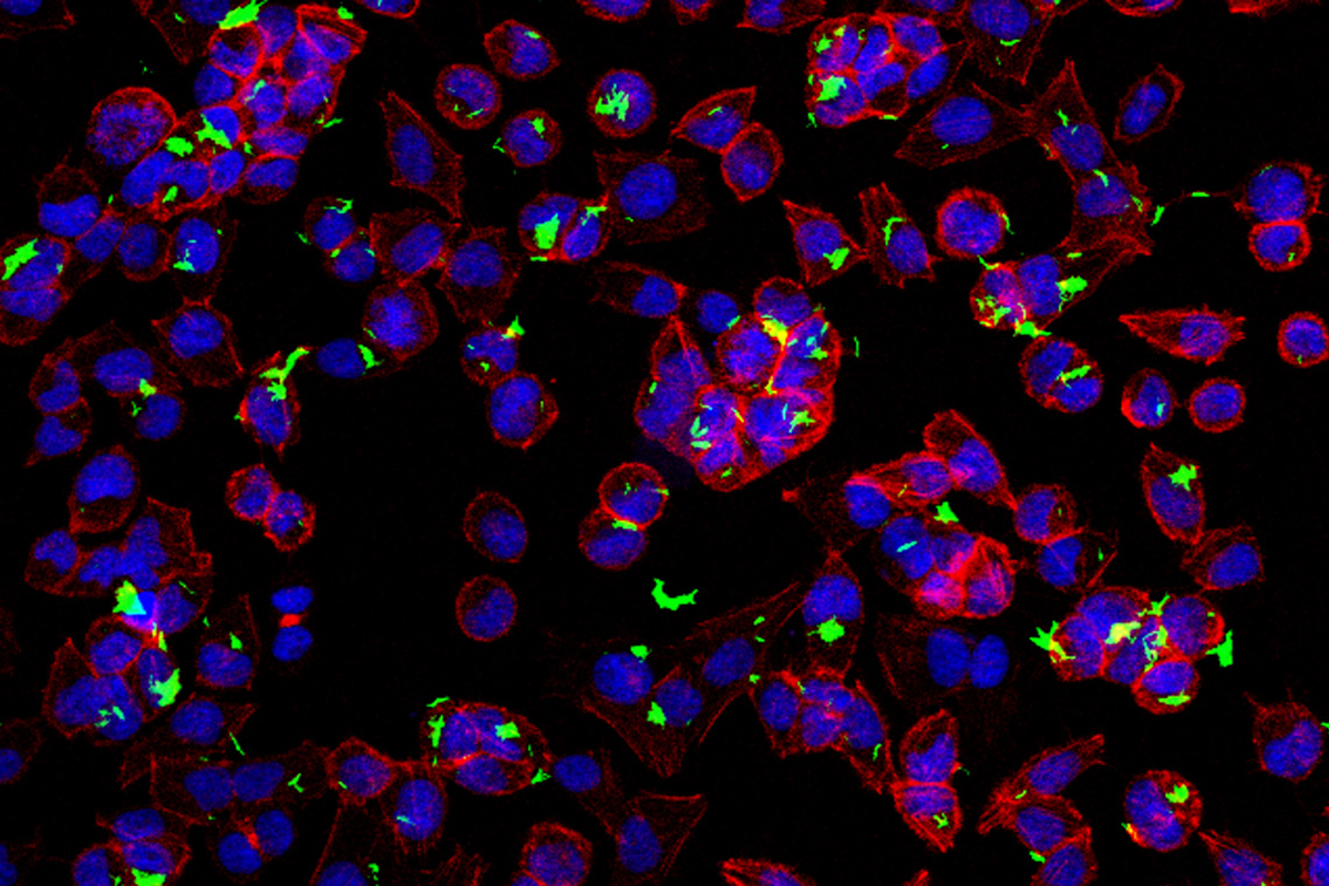 Picutred: Bladder Cancer Cells