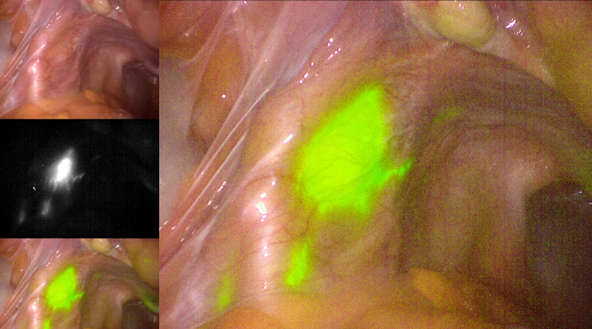 Indocyanine green and near-infrared imaging to visualize the sentinel lymph node.