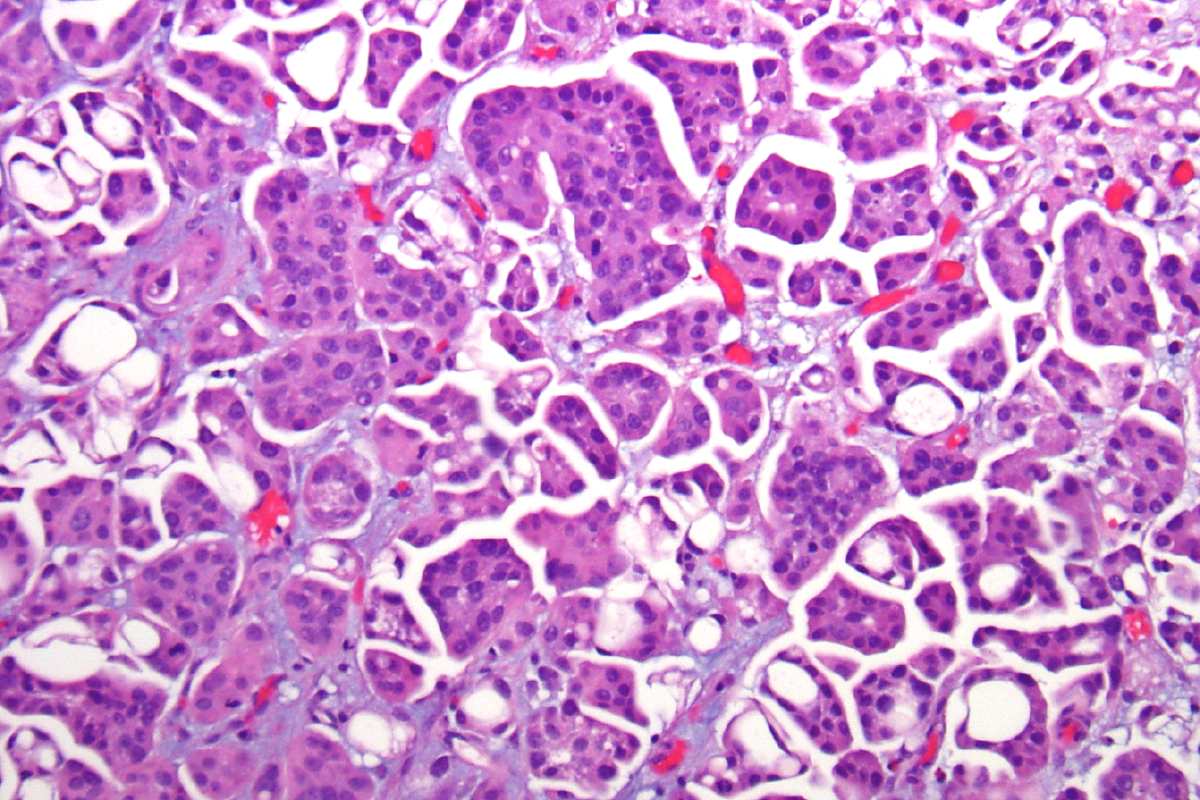 Figure 1. Micropapillary bladder cancer. Small, slender, and tight papillary clusters in lacunar spaces are characteristic of micropapillary carcinoma.