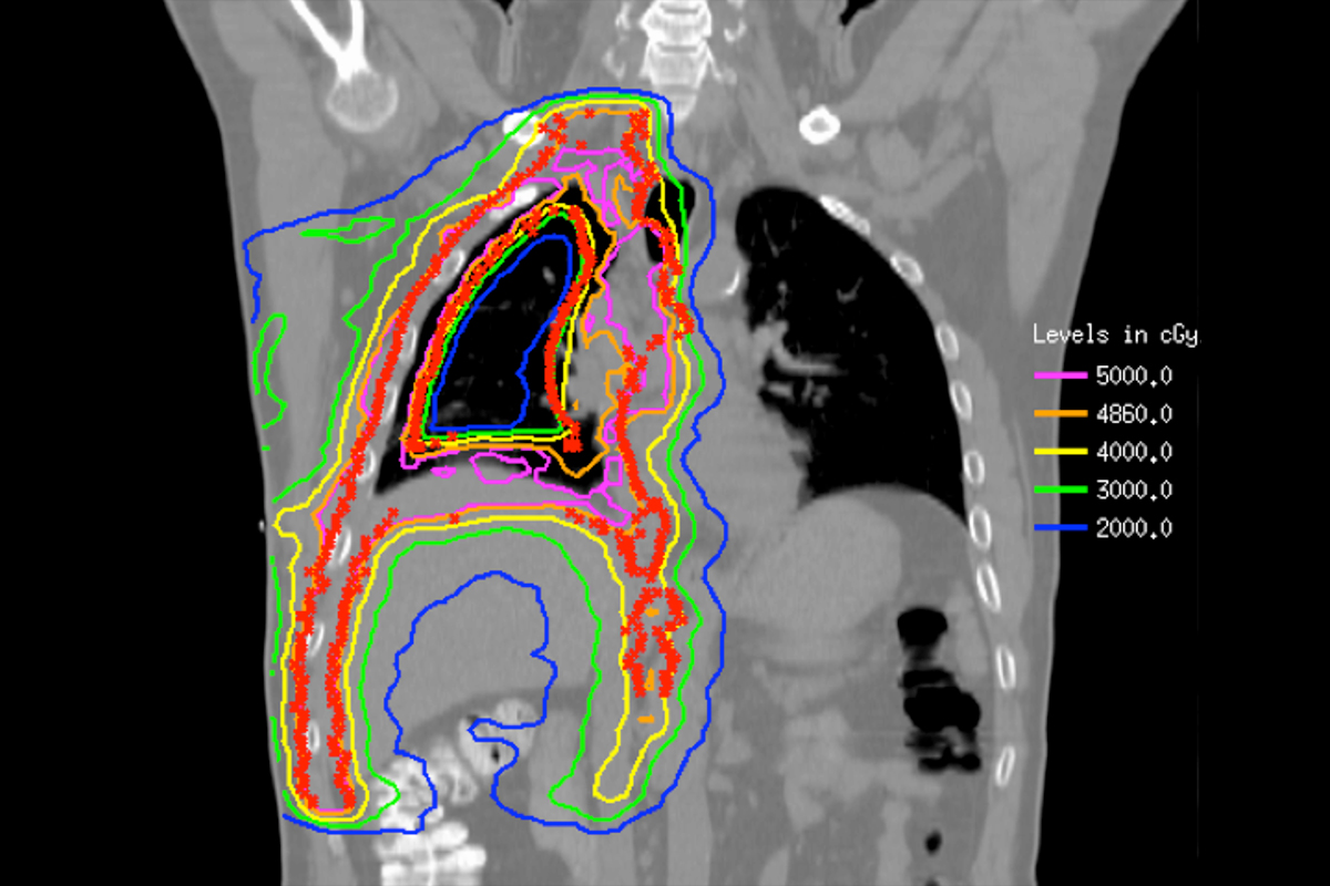 Hemithoracic pleural intensity-modulated radiation therapy plan (coronal view) of a right-sided malignant pleural mesothelioma