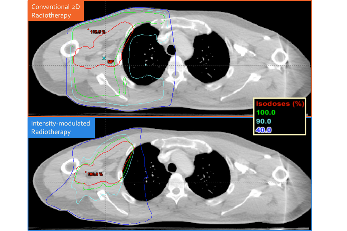 Figure 3.  Comparison of adjuvant radiotherapy for resected high-risk axillary lymph node metastases from cutaneous melanoma using conventional 2-D and intensity-modulated techniques. In this case, intensity-modulated radiotherapy provides a more homogeneous dose of radiation to a limited target volume and prevents unnecessary irradiation of the lung and subcutaneous tissues, possibly reducing the side effects of treatment.