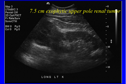 7.5 cm (T2) exophytic upper pole renal mass amenable to partial nephrectomy