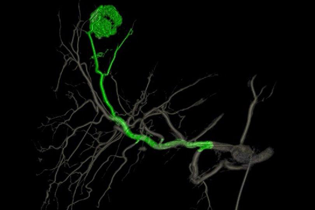 Figure 3 -- FlightPlan for Liver software (GE Healthcare, Waukesha, WI, USA) detects the tumor feeding artery (shown in green) using three-dimensional CBCT data. A. (Below) Angiographic study demonstrating the tumor blush in segment VIII of the liver.  B. (Above) FlightPlan showing the feeding artery.  