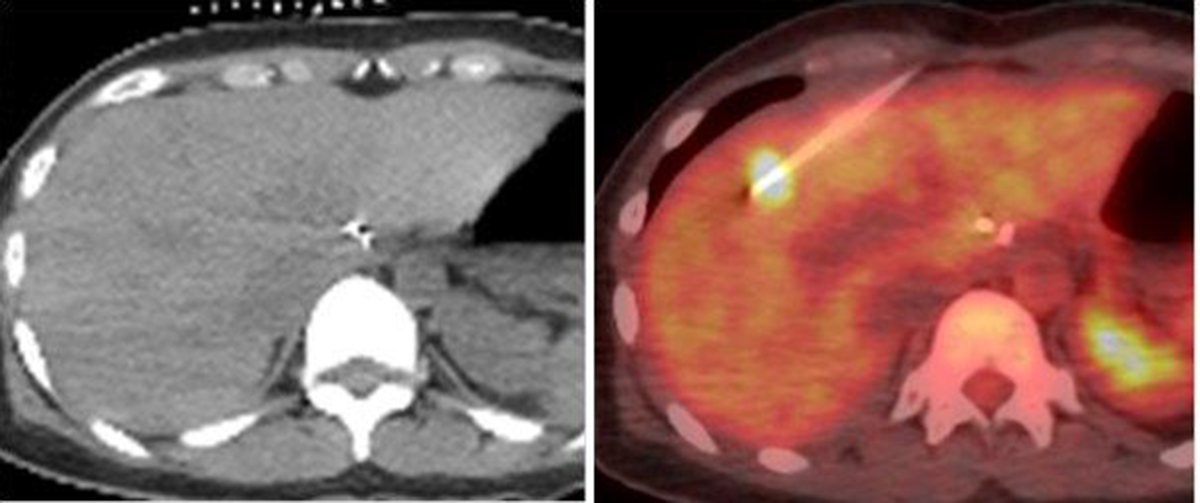 18FDG PET/CT-guided biopsy of the liver.