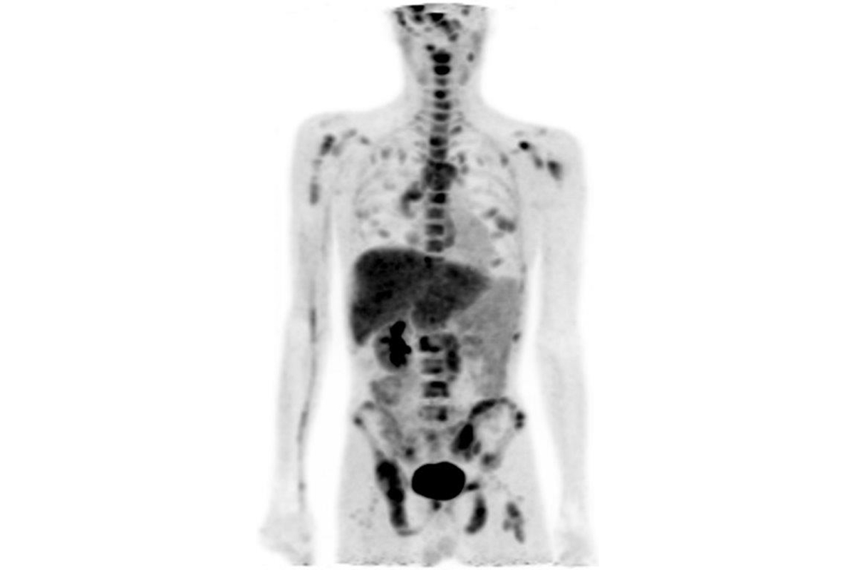 Figure 1 -- Fluoroglutamine PET scan of a renal cancer patient with widespread tracer-avid metastatic disease.