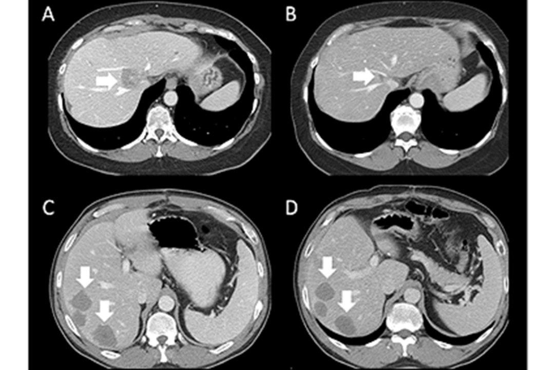 Figure 1 -- Contrast-enhanced CT axial images obtained during the portal venous phase before treatment (A, C) and after two months of chemotherapy (B, D). The patient with a marked volumetric response (A, B) had greater tumor enhancement heterogeneity at baseline (A).