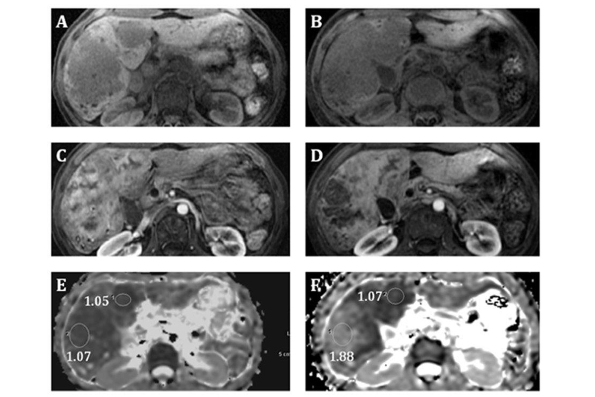 Figure 3 -- MRI of the liver pre (A, C, E) and post (B, D, F) arterial embolization, demonstrating increased tumor sizes on pre contrast T1 weighted imaging (A, B), but decreased enhancement on post contrast arterial phase (C, D), and increased apparent diffusion coefficients (E, F) of right hepatic metastases.