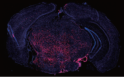 Engineered human ES cell progeny form tumors in the brainstem, modeling pediatric tumors