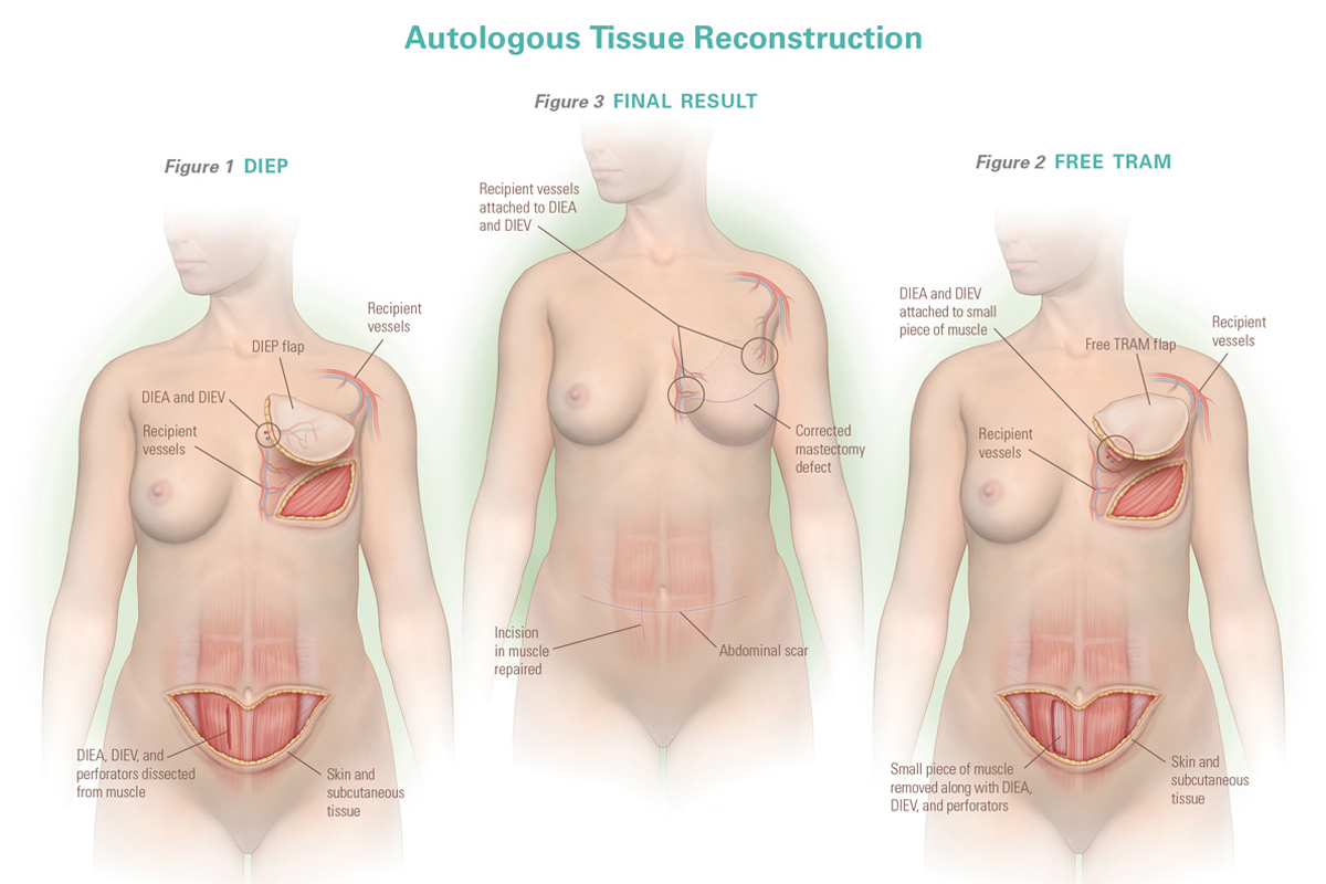 Autologous Tissue Reconstruction