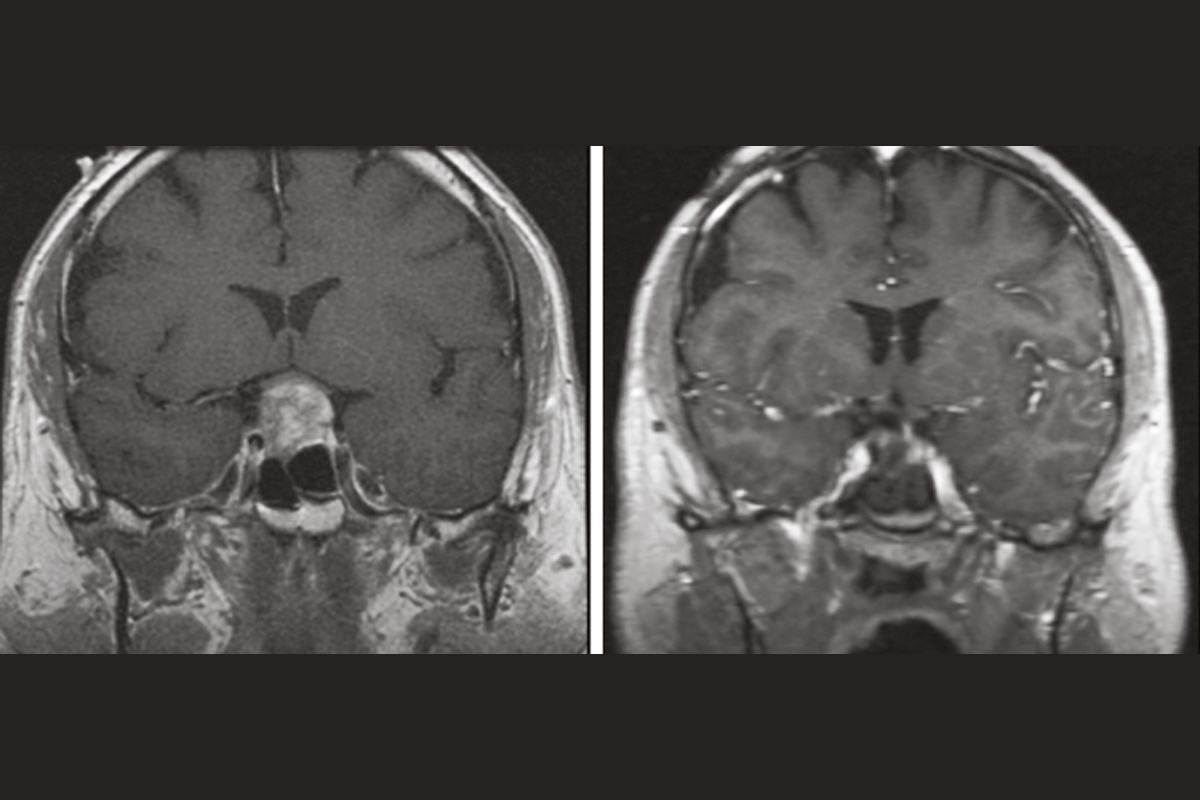Pituitary gland MRI