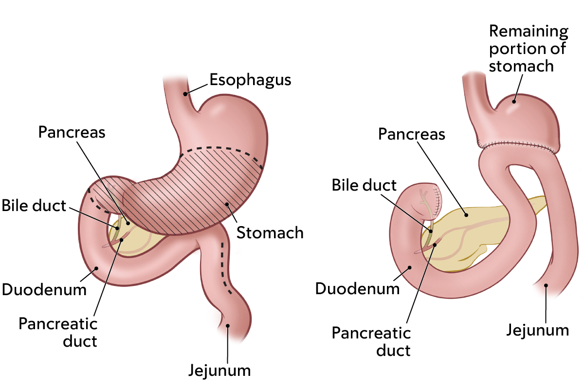 The digestive system before a partial gastrectomy (left). The digestive system after a partial gastrectomy (right).
