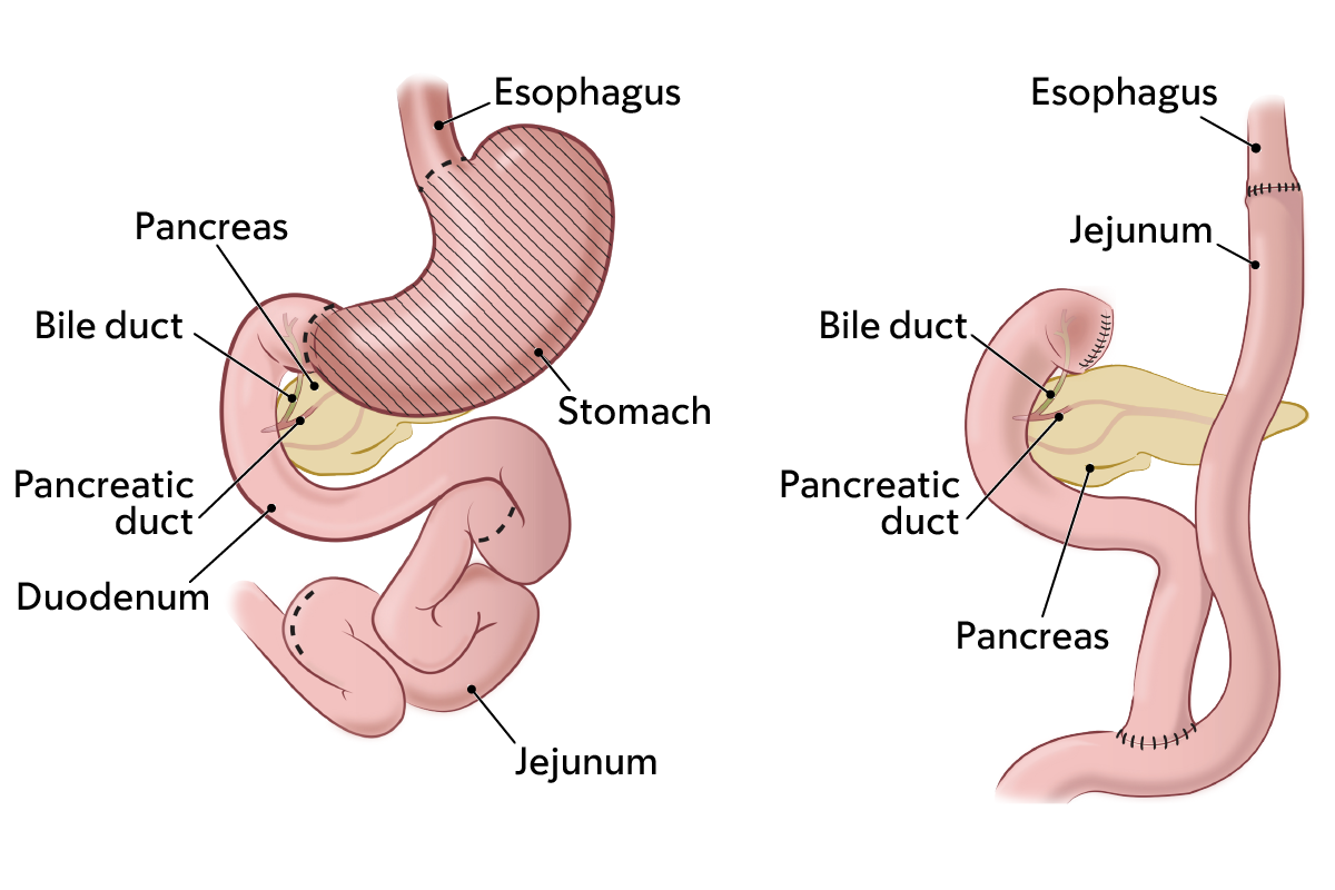 The digestive system before a total gastrectomy (left). The digestive system after a total gastrectomy (right).