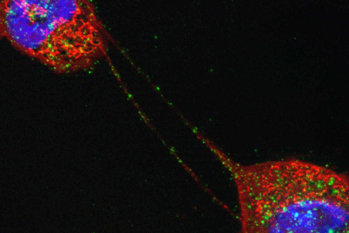 Two mesothelioma cells connected by long extensions called tunneling nanotubes, which potentially may be a conduit for communication between the cells.