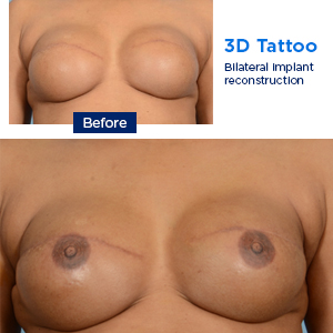 Photos show before and after images of nipple and areola tattoos done by MSK specialists after breast surgery.