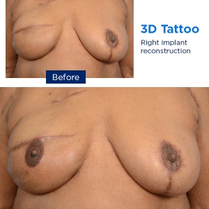 Las fotos muestran el antes y después del procedimiento, con tatuajes de areola y pezón realizados por especialistas de MSK después de una cirugía de mama.