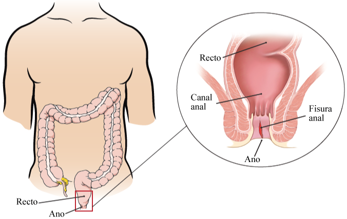 Acerca de las fisuras anales  Memorial Sloan Kettering Cancer Center