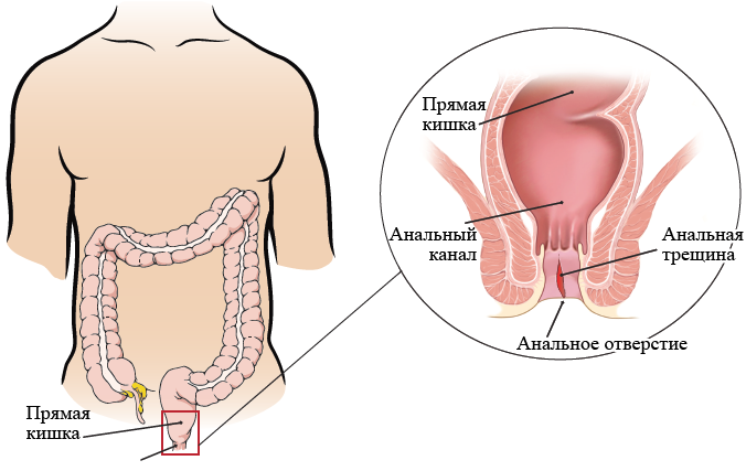 Разрыв анала