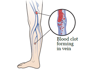 Figure 1. Deep vein thrombosis in your leg