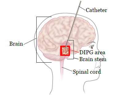 Рисунок 3.  Катетер в стволе головного мозга