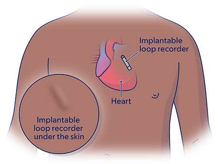 Back Pain Releif with Implantable Devices State of the Art