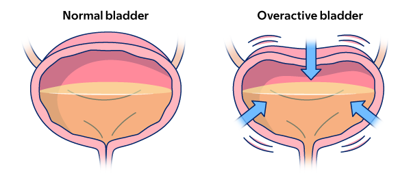 Figure 1. Normal bladder (left) and overactive bladder (right)