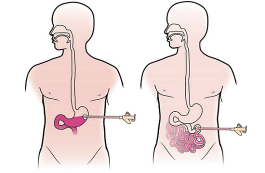 Figure 1. PEG tube placement (left) and PEJ tube placement (left)