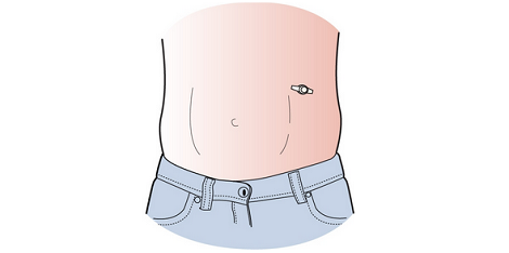 Figure 2. Low-profile gastrostomy button