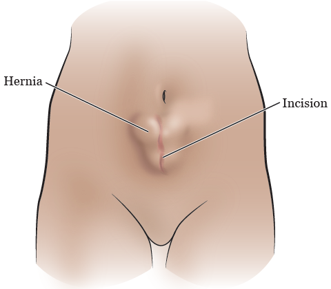 Figura 1. Una hernia abdominal