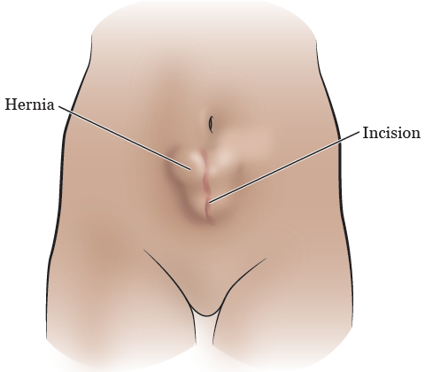 About Your Abdominal Incisional Hernia Surgery