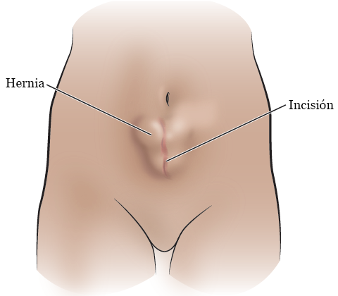 Figura 1. Una hernia abdominal