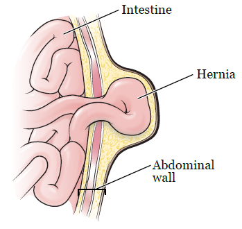 What happens to the Hernia Mesh inside the body over time?