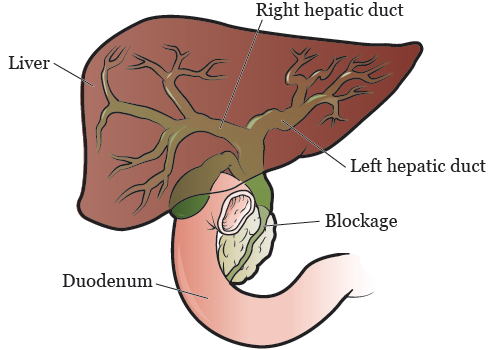 Figure 1. Narrow or blocked flow of bile