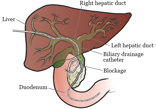 Figure 2. Internal-external biliary drainage catheter