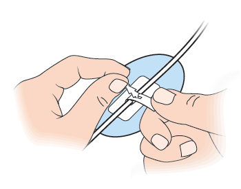 Figure 9. Securing the catheter in the CathGrip