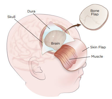Figure 1. Brain tumor removal surgery