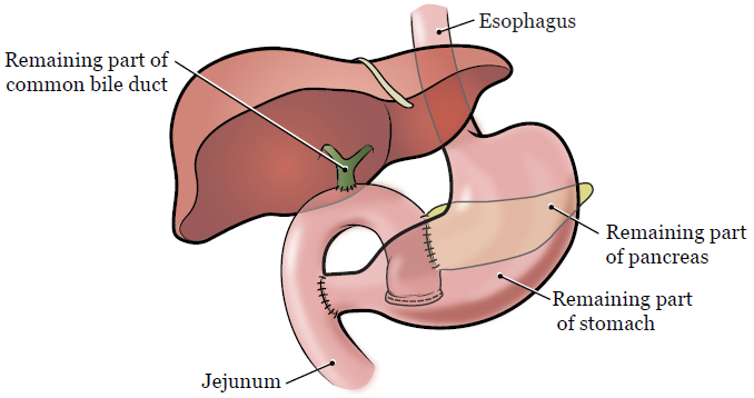 Рисунок 2.  Поджелудочная железа и окружающие органы после операции