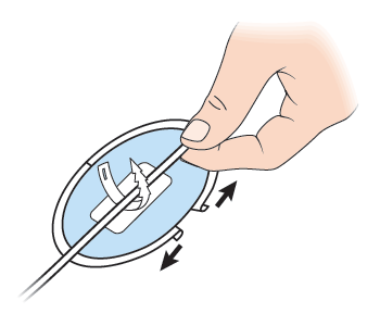 Figure 7. Placing the catheter and removing the paper back of the CathGrip