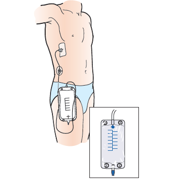 Figure 9. Drainage bag below the catheter