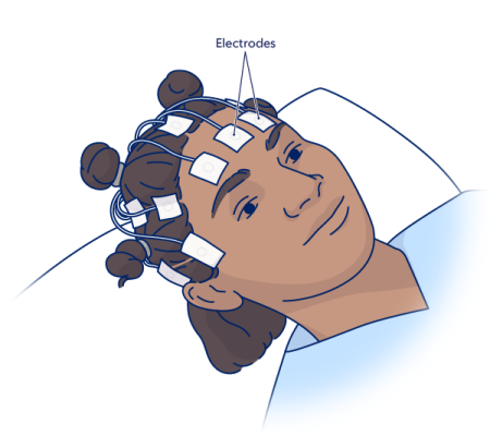 Figura 1. Electrodos en el cuero cabelludo durante un EEG