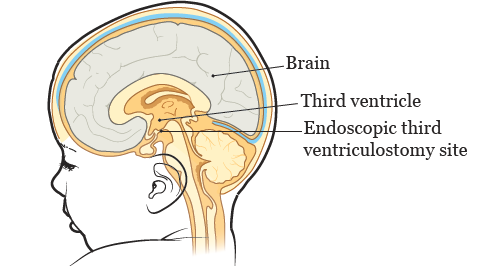 Figure 2. Endoscopic third ventriculostomy (ETV)