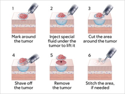 Figura 2. Proceso de extirpación del tumor