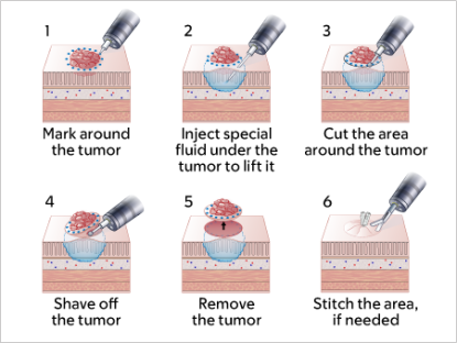 Figure 2. Tumor removal process.