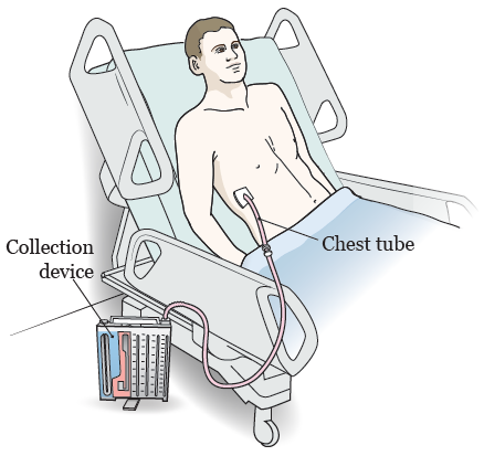 Figure 2. A chest tube with a drainage device