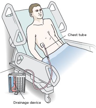 Figure 13. A chest tube with a drainage device