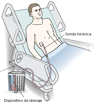 Figura 13. Drenaje torácico con un dispositivo para drenar