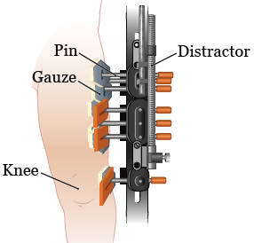 Figure 2. Thigh pin and wires wrapped in gauze