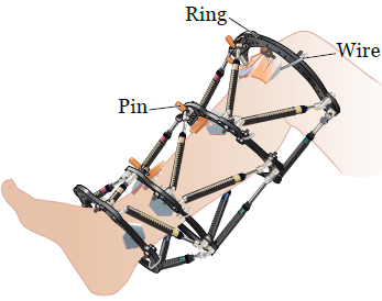 Figura 3. Tornillo de la pierna y alambres envueltos en gasa
