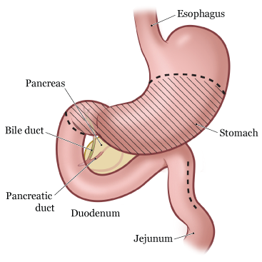 Рисунок 2.  Пищеварительная система до субтотальной гастрэктомии