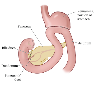Рисунок 3.  Пищеварительная система после субтотальной гастрэктомии